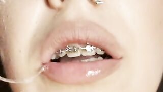 Gag reflex. Drooling and gagging by metal mouth