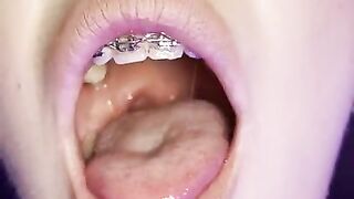 Gag reflex. Drooling and gagging by metal mouth