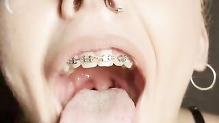 Gag reflex. Drooling and gagging by metal mouth