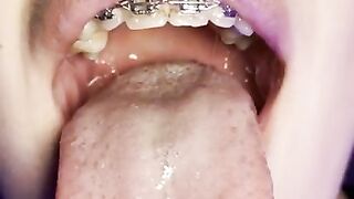 Gag reflex. Drooling and gagging by metal mouth