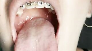 Gag reflex. Drooling and gagging by metal mouth