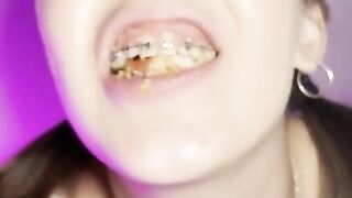 Food crush. Girl with braces chewing food