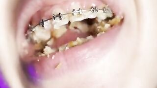 Food crush. Girl with braces chewing food