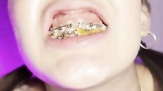 Food crush. Girl with braces chewing food