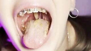 Food crush. Girl with braces chewing food